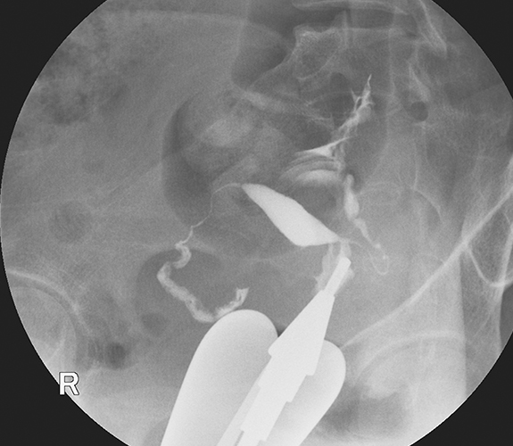 Histerosalpingografi (HSG)